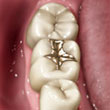 gold fillings