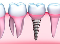 dental implant detailed view