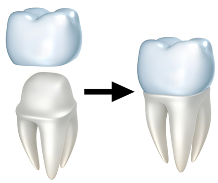 dental crowns example