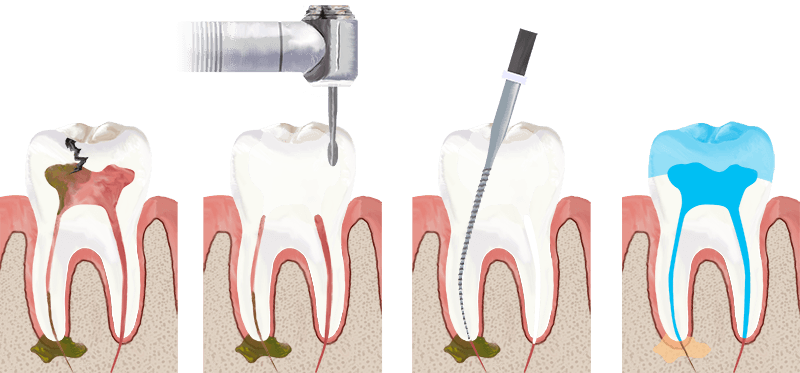 root canal therapy