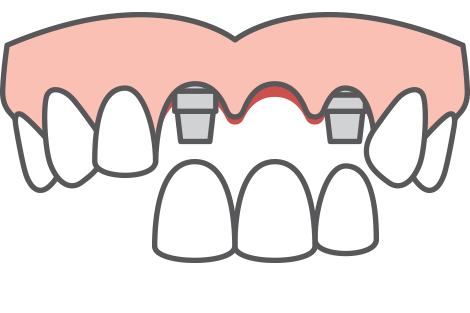 service blurb multiple tooth implants