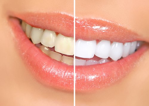 teeth whitening cardinia dental clinic