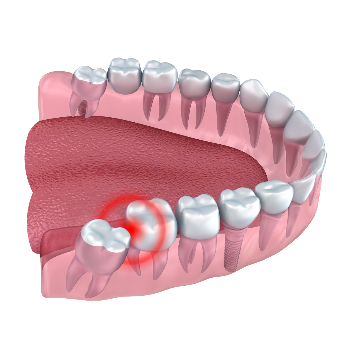 Wisdom Teeth Removal Cardinia Dental