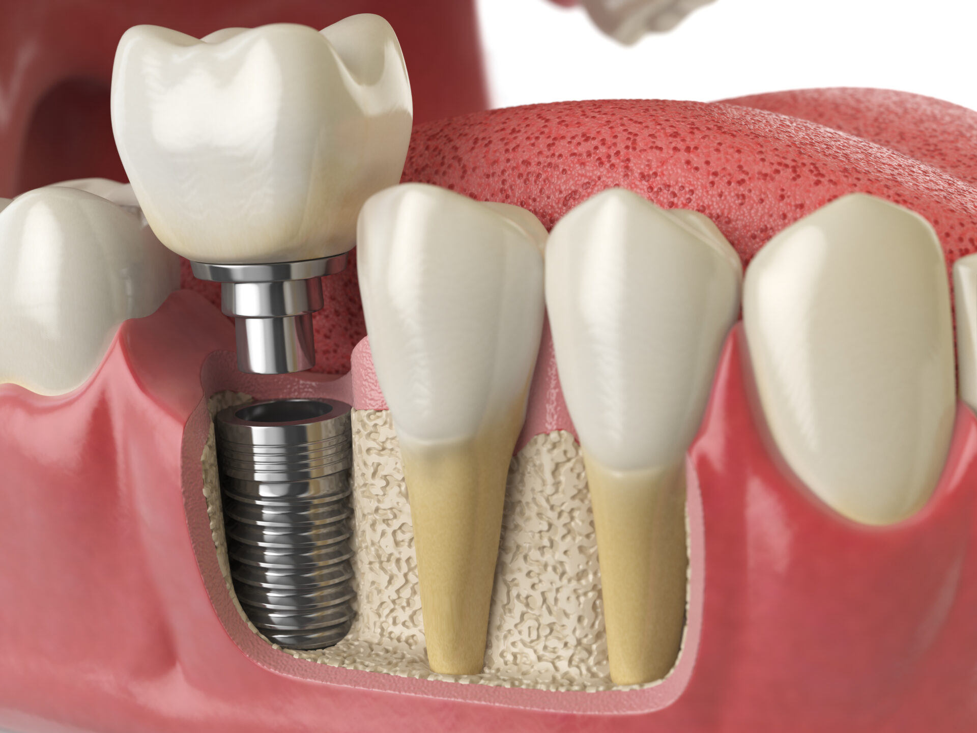 implant dentist pakenham - dental implant process at cardinia dental