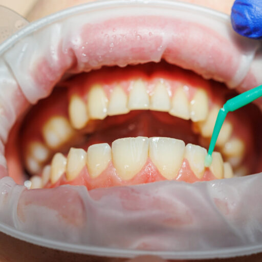 cosmetic bonding with cosmetic dentist in pakenham | Cardinia Dental