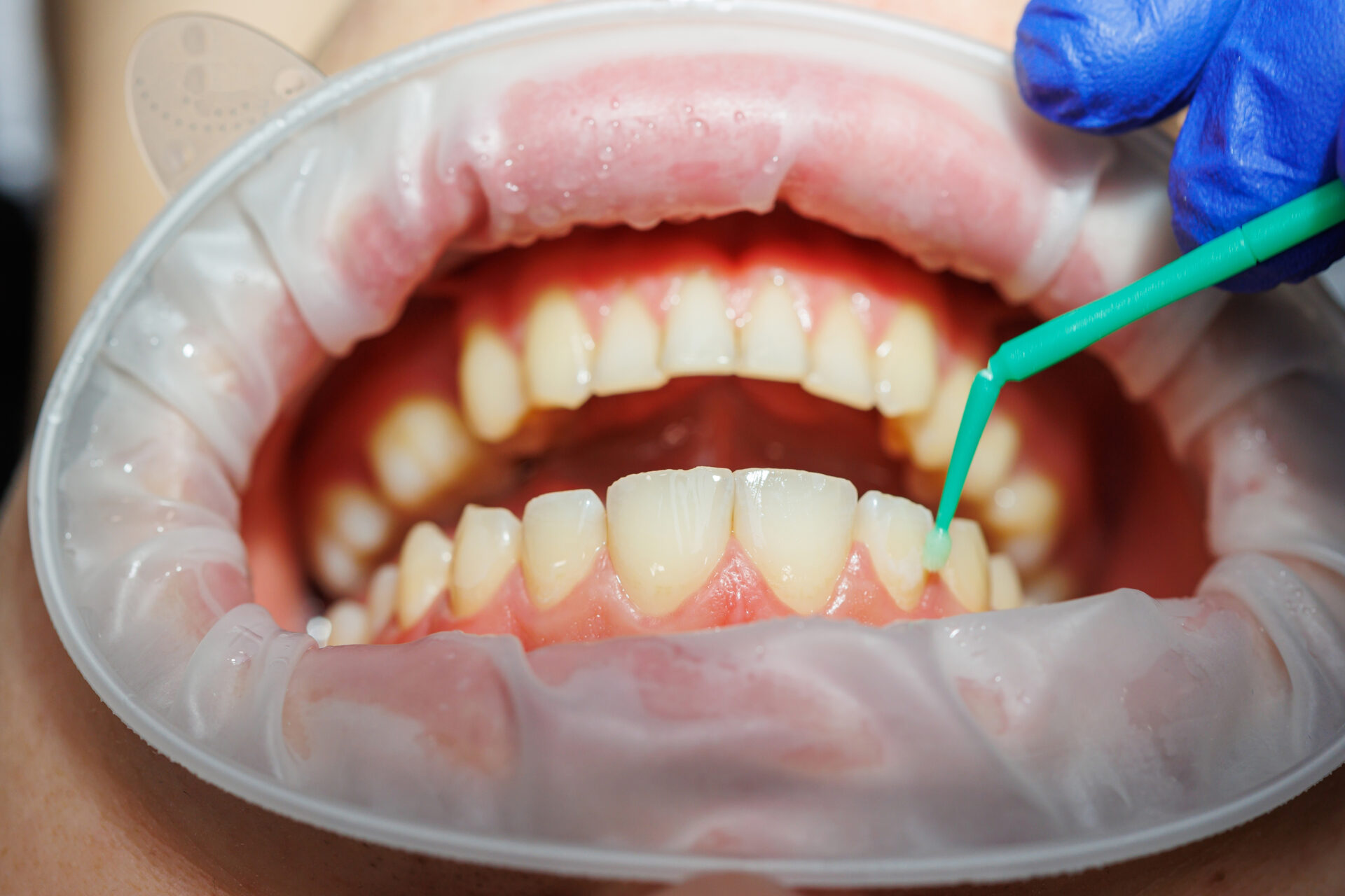 cosmetic bonding with cosmetic dentist in pakenham | Cardinia Dental